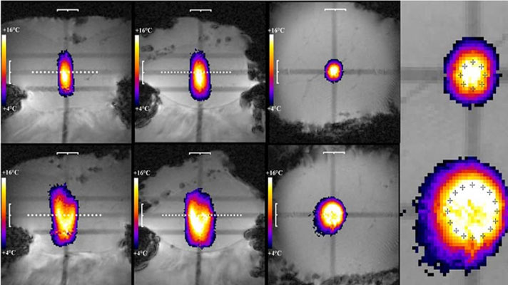 MRgHIFU Ablation of Liver Tumors